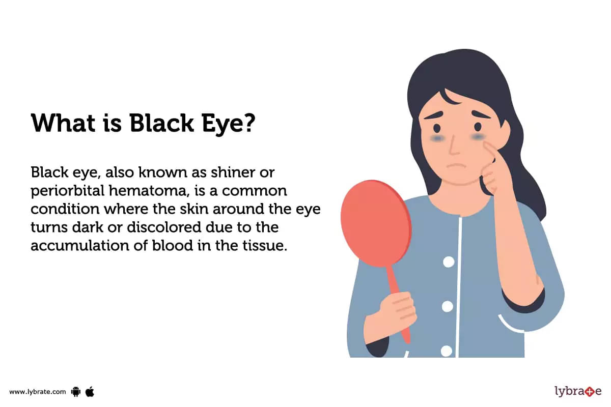 Black Eye (periorbital haematoma): Causes, Symptoms, Risk Factor