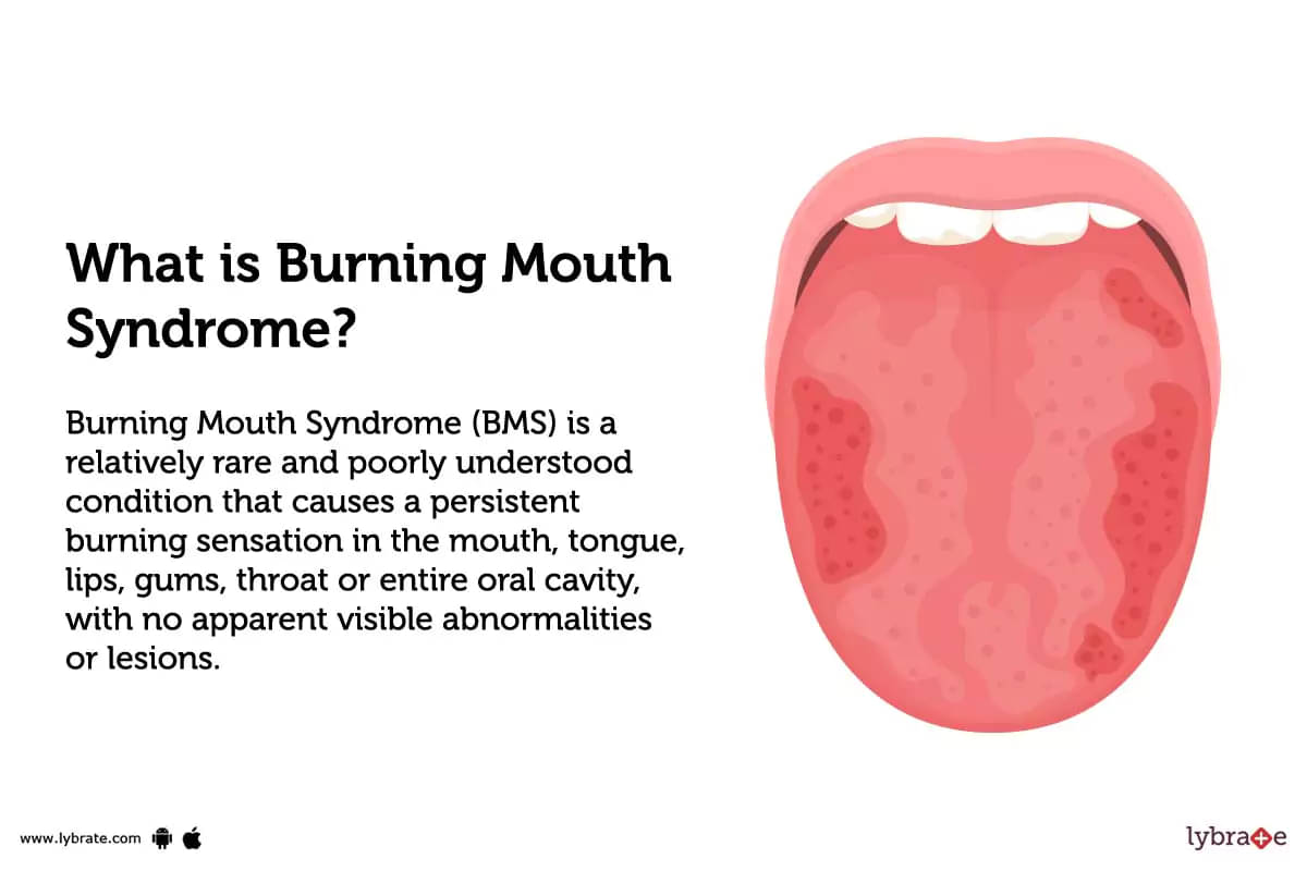 Burning Mouth Syndrome Treatment Procedure Cost Recovery Side