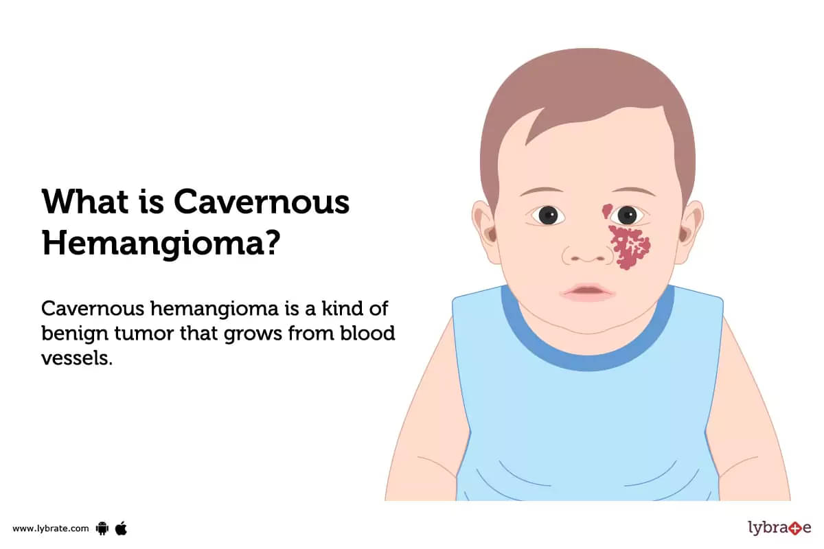 cavernous hemangiomas