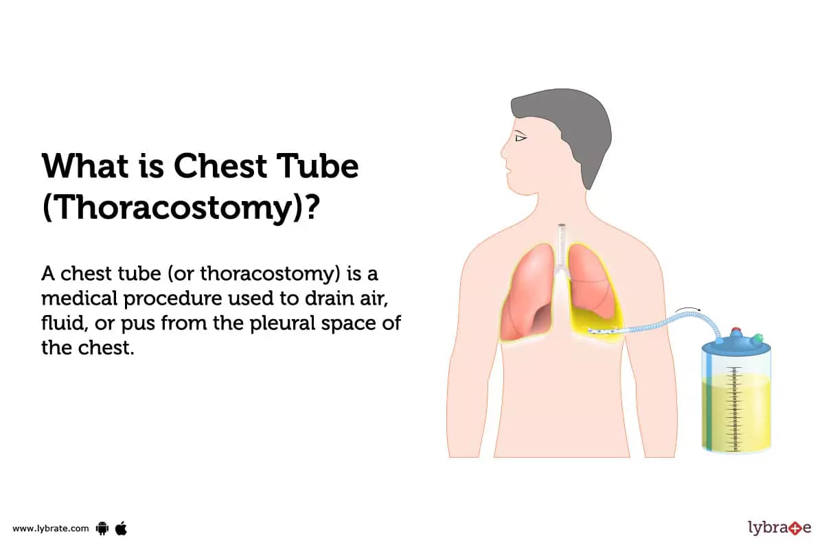 Chest Tube (Thoracostomy): Causes, Symptoms, Treatment and Cost