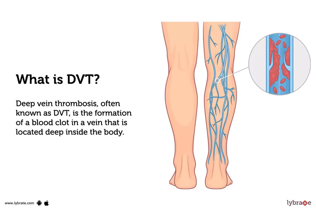 What are the symptoms of a blood clot?