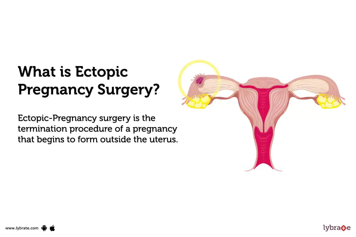 ectopic-pregnancy-surgery-purpose-procedure-benefits-and-side-effects