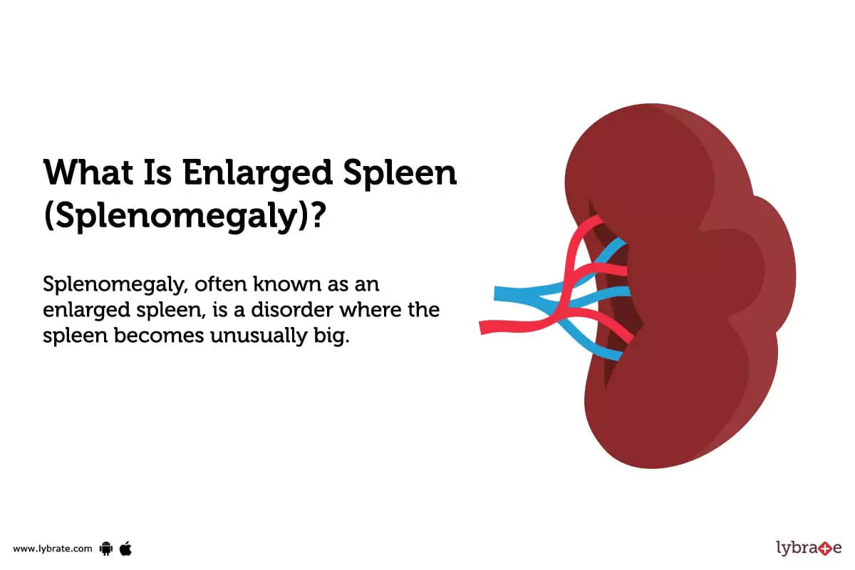 Symptoms and Causes of Enlarged Spleen (Splenomegaly)