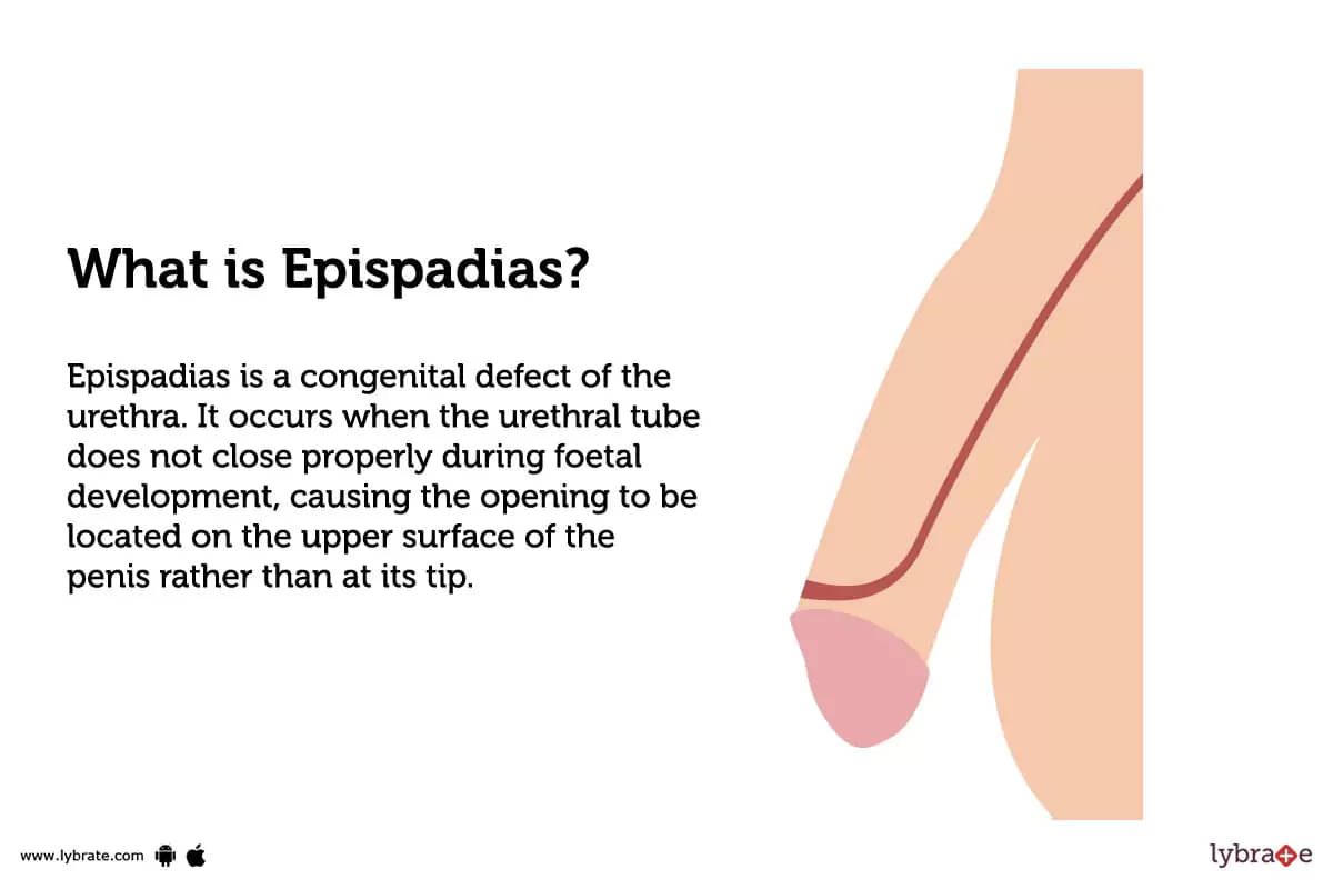 epispadias and hypospadias