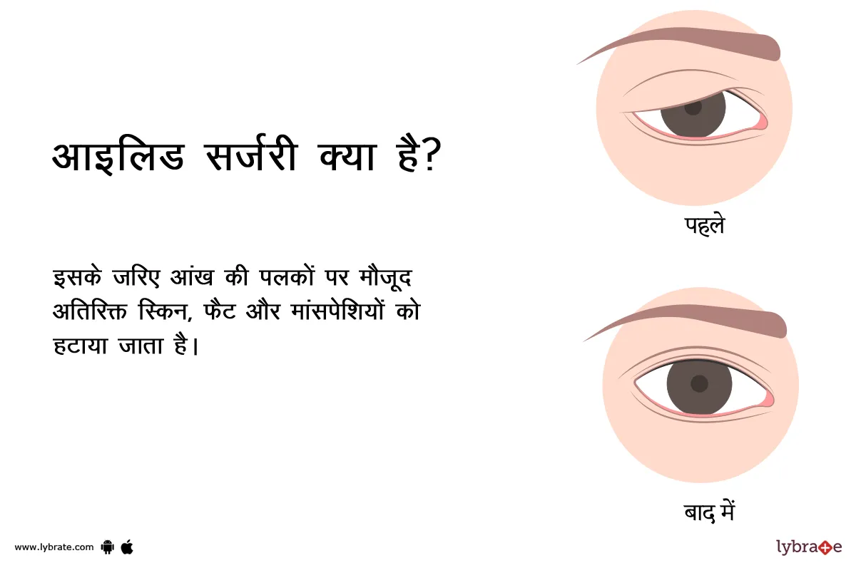 आइलिड सर्जरी क्या है?