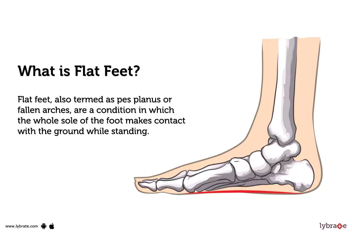 Conservative and Invasive Treatments for Flat Feet - Custom