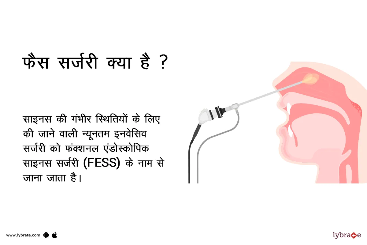 फैस सर्जरी क्या है ? - FESS Surgery kya hai?