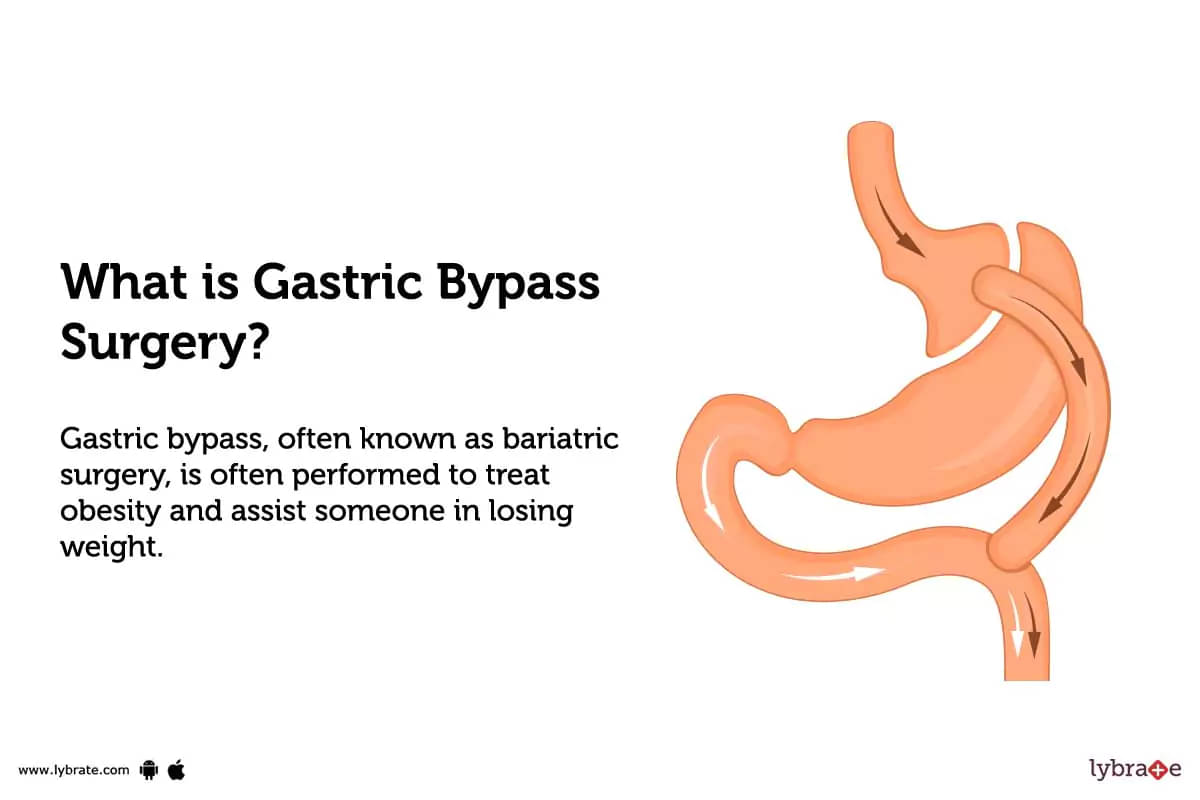 Gastric Bypass Surgery: Procedure, Recovery, Cost, Risk & Complication