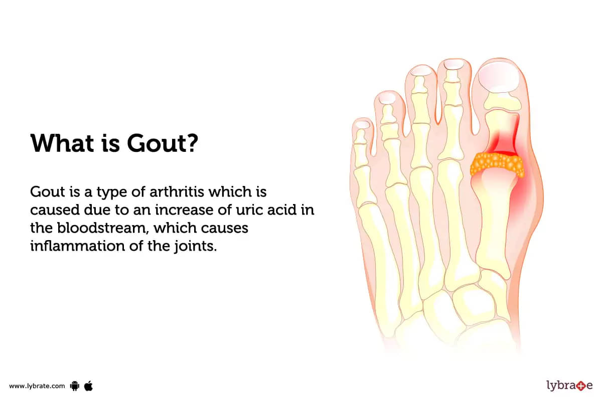 Gout: Causes, Symptoms, Treatment and Cost