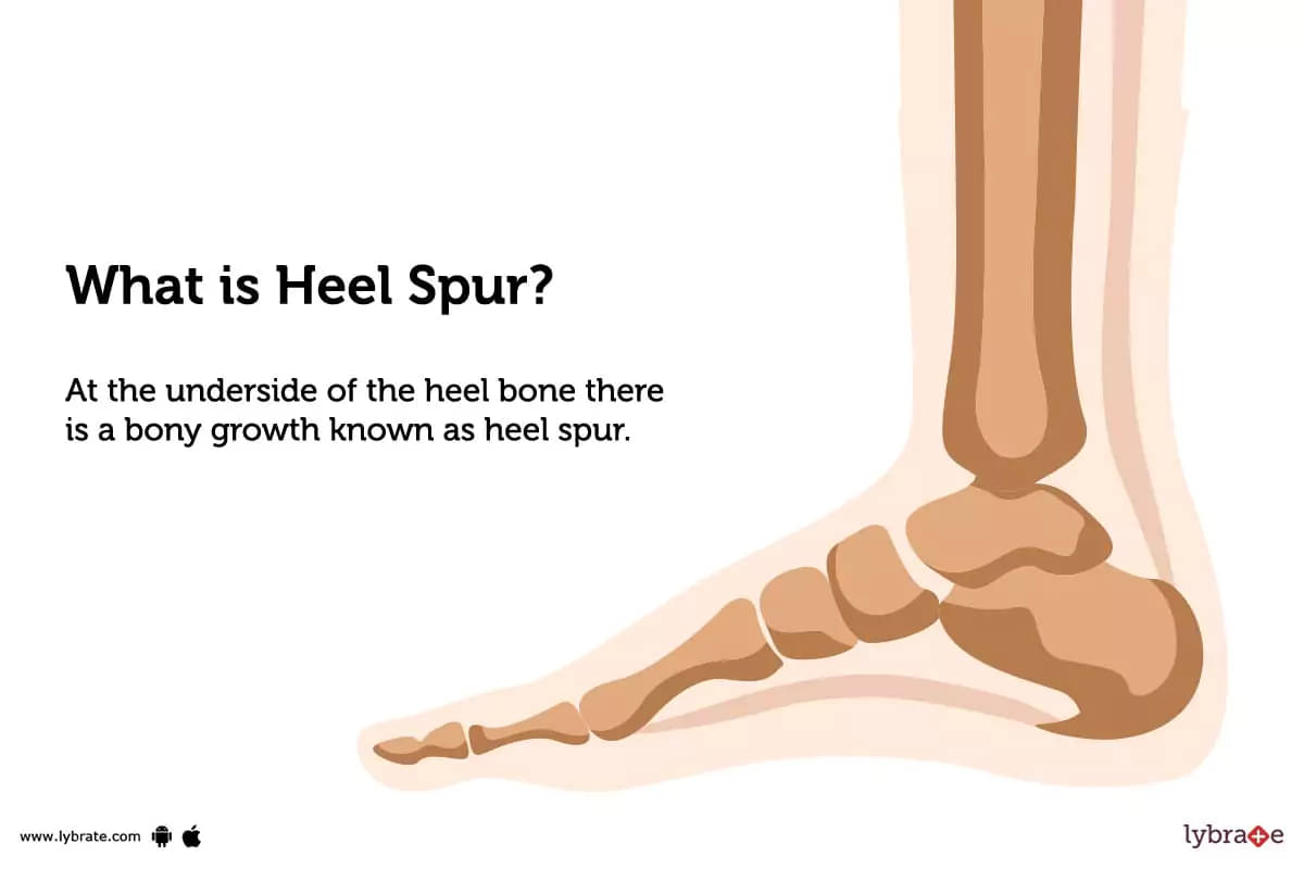 Heel Spur: Causes, Symptoms, Treatment and Cost