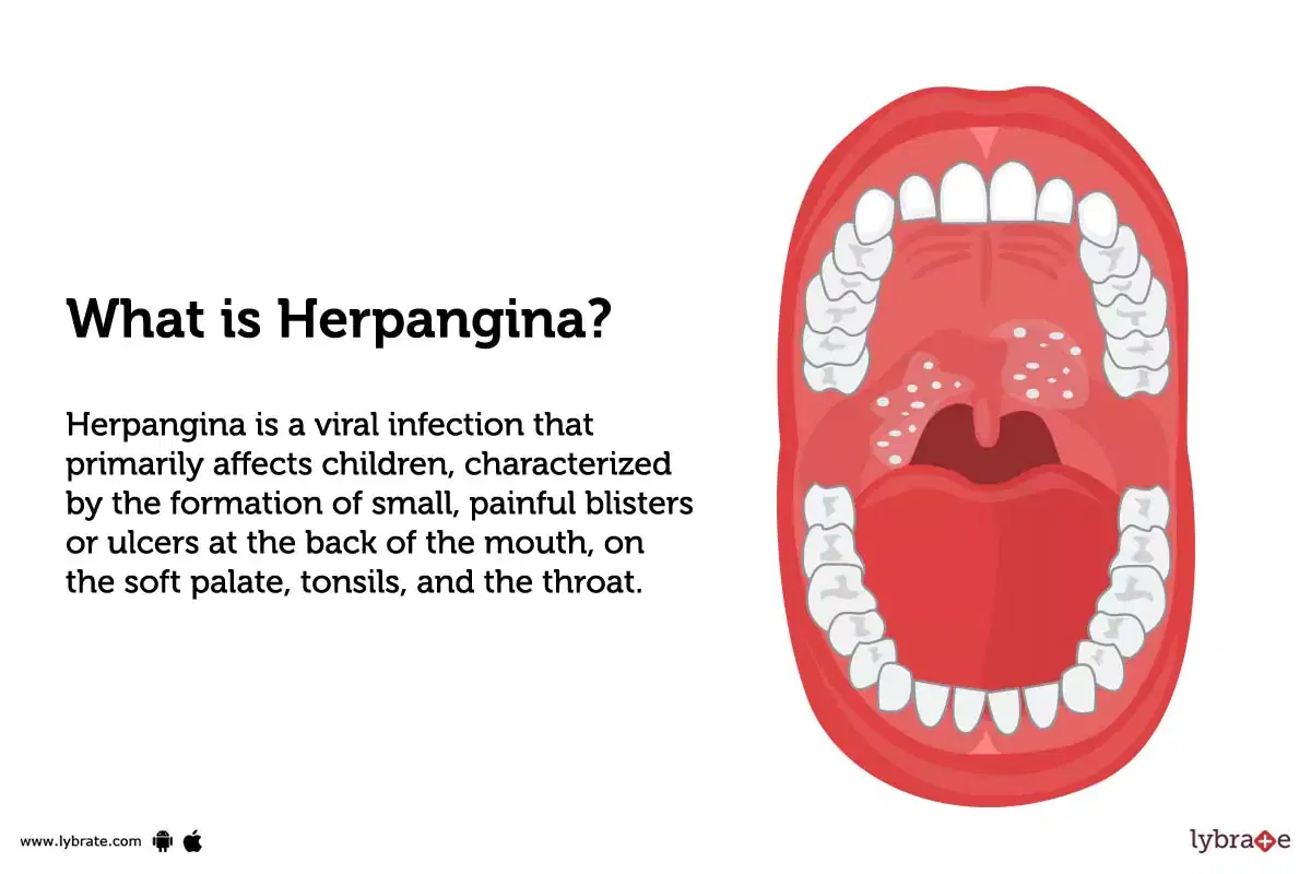 what causes blisters in throat