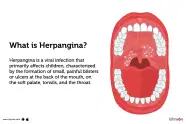 Herpangina Causes Symptoms Treatment