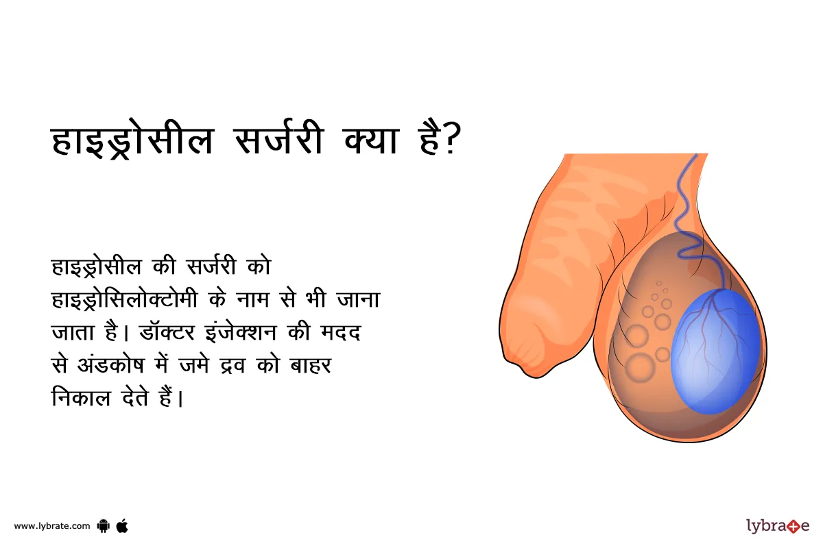 हाइड्रोसील सर्जरी क्या है?