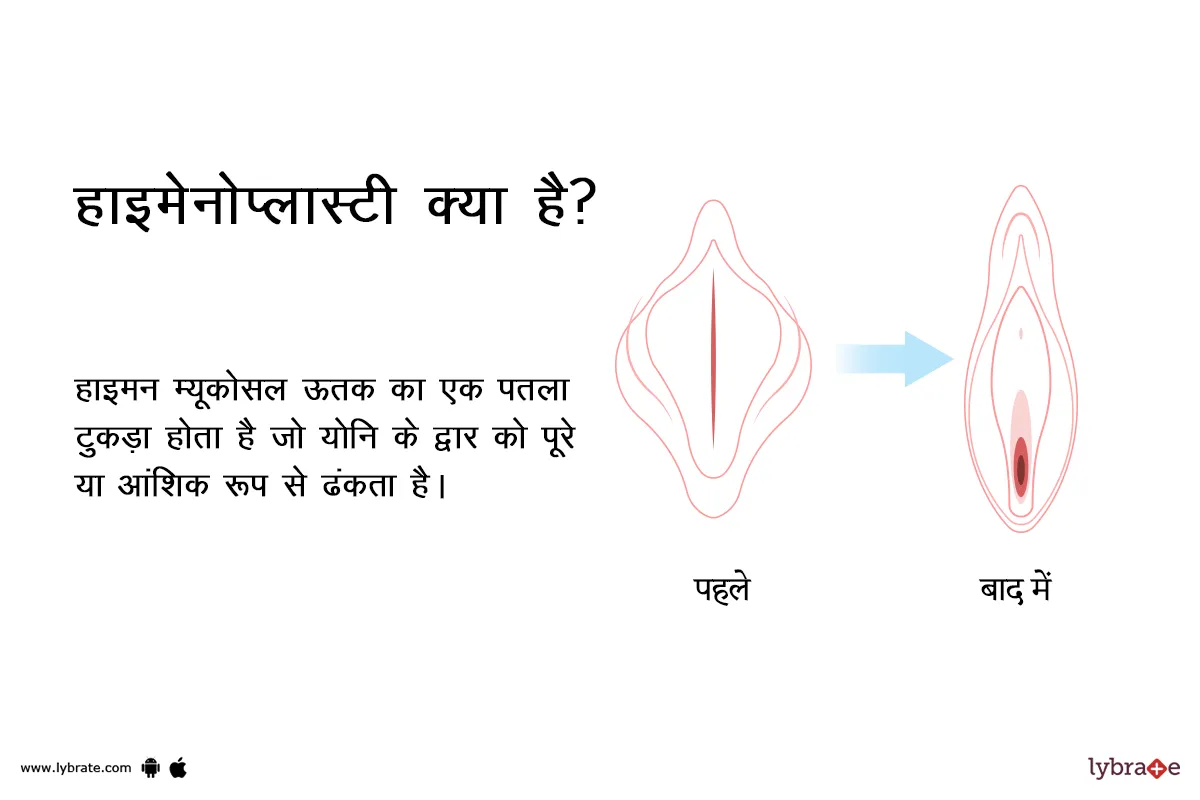 हाइमेनोप्लास्टी क्या है? | What is Hymenoplasty in Hindi