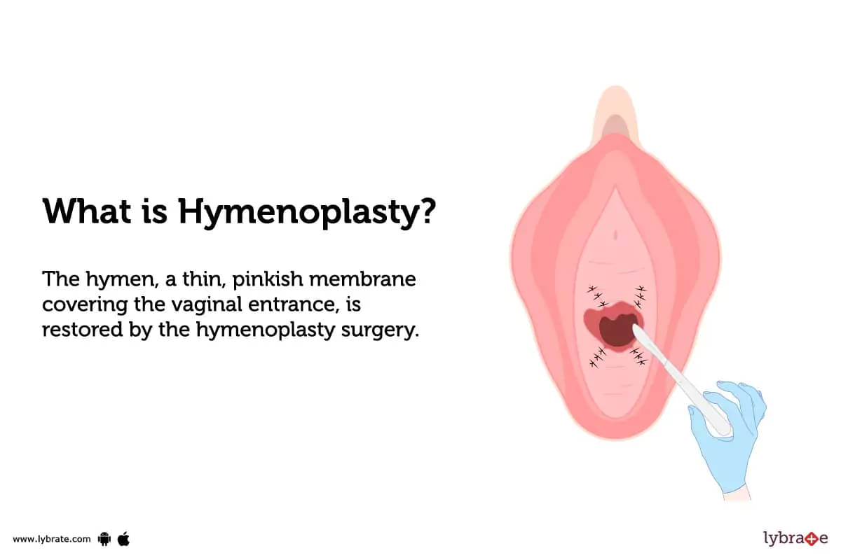 Hymenoplasty Procedure, Recovery, Cost And Side Effects Of Hymenoplasty Treatment image