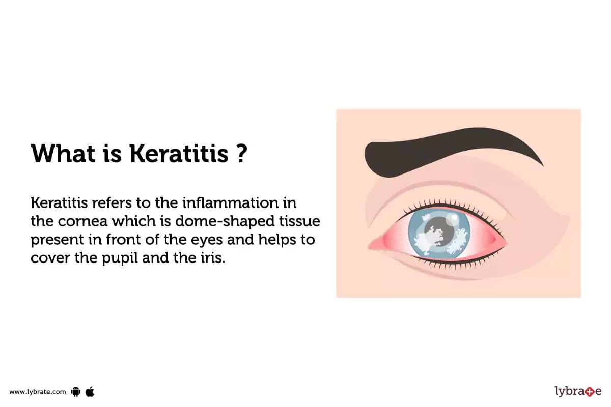 bacterial keratitis symptoms