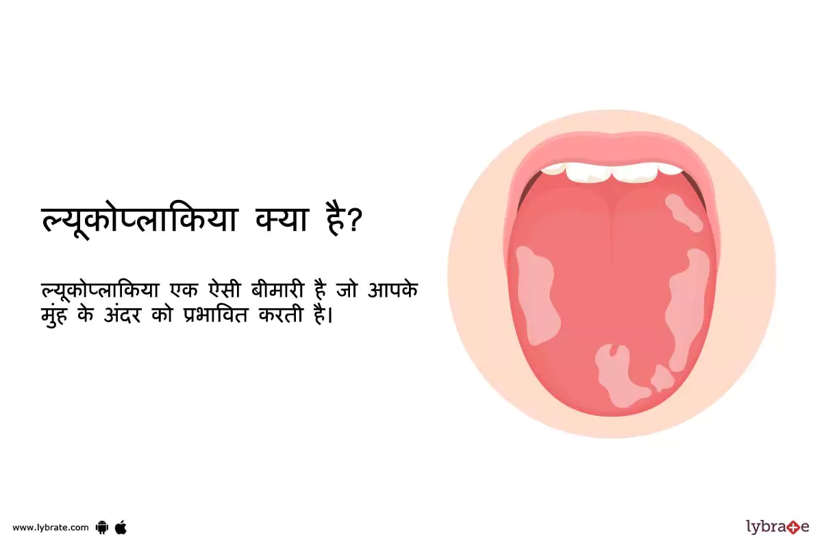 ल्यूकोप्लाकिया क्या है?