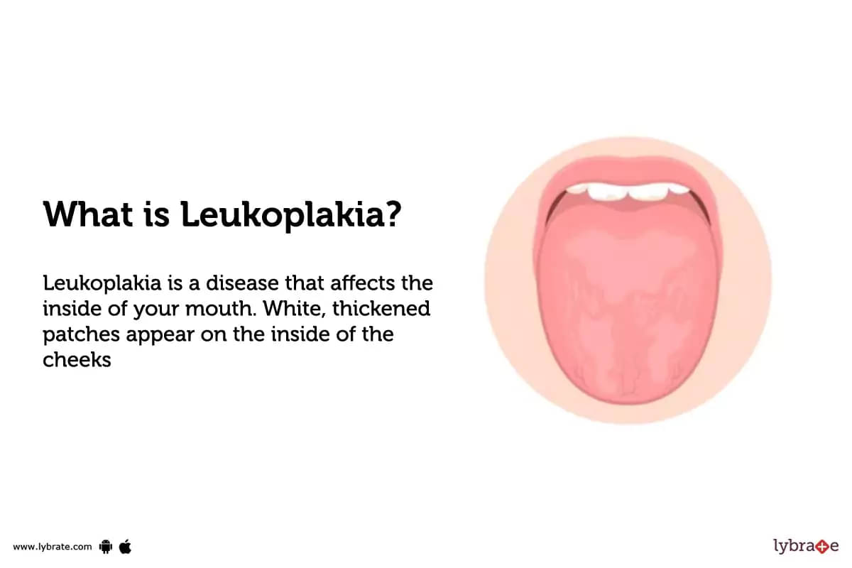What Is Leukoplakia.webp
