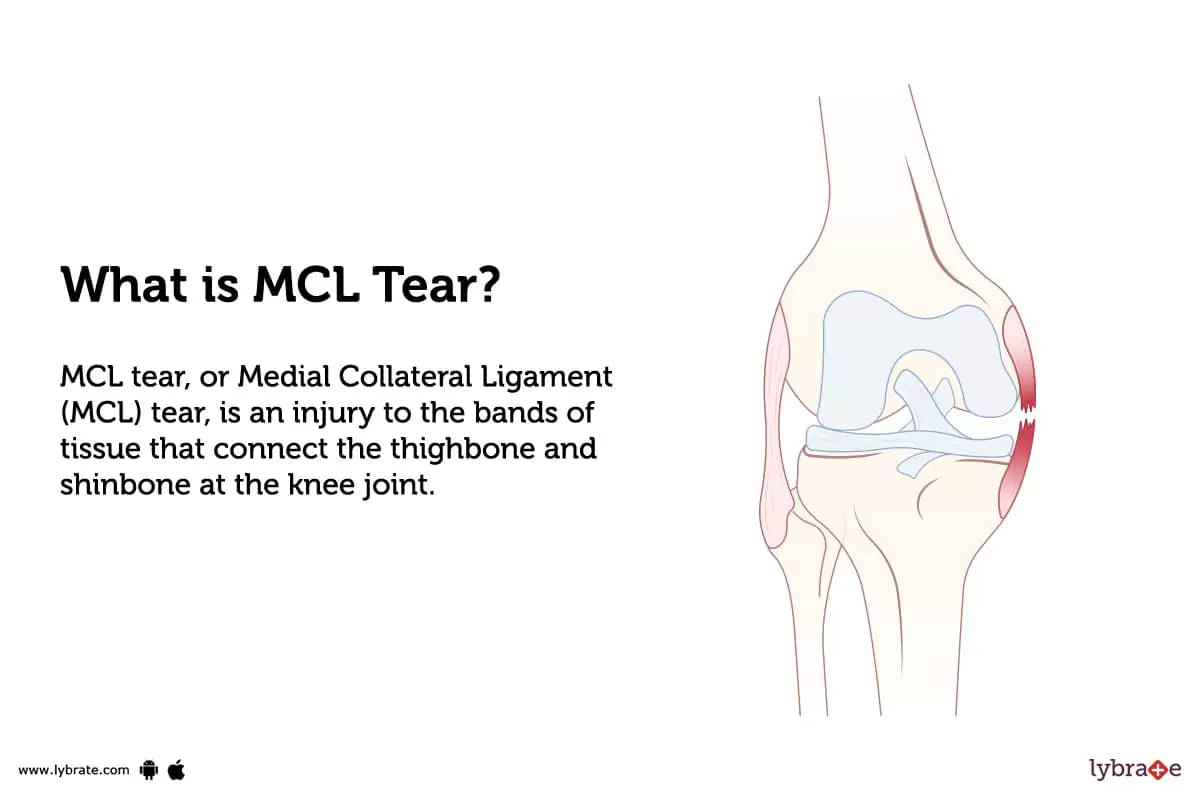 Medial Collateral Ligament Injuries of the Knee (MCL Tear)