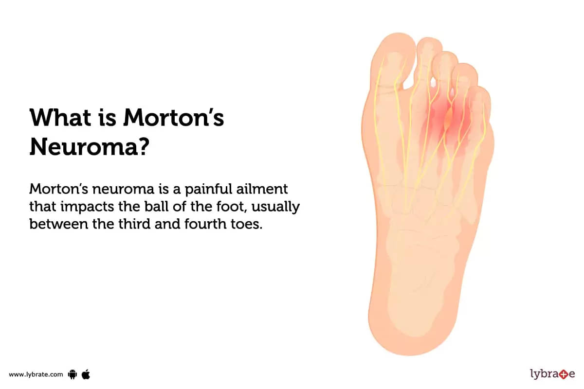 Carpal tunnel syndrome explained  Dr Morton's - the medical helpline