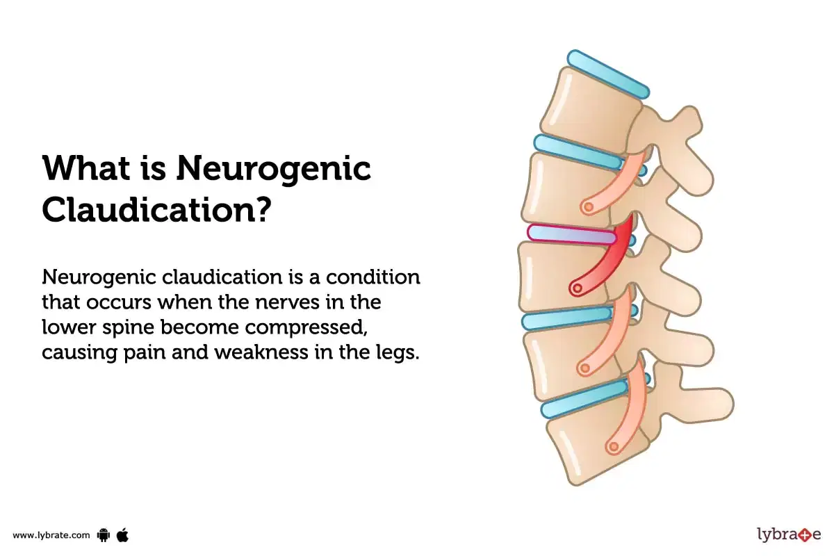 Spinal stenosis and neurogenic claudication - Lubbock, Amarillo, Midland