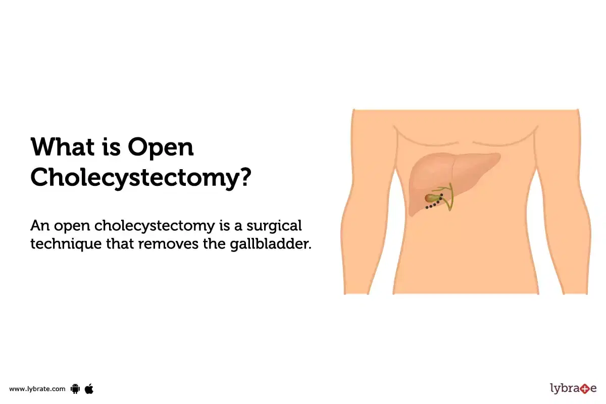 open-cholecystectomy-causes-symptoms-treatment-and-cost