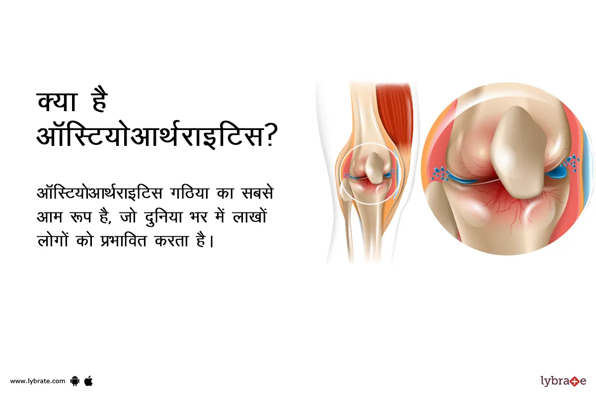 क्या है ऑस्टियोआर्थराइटिस? | What is Osteoarthritis?