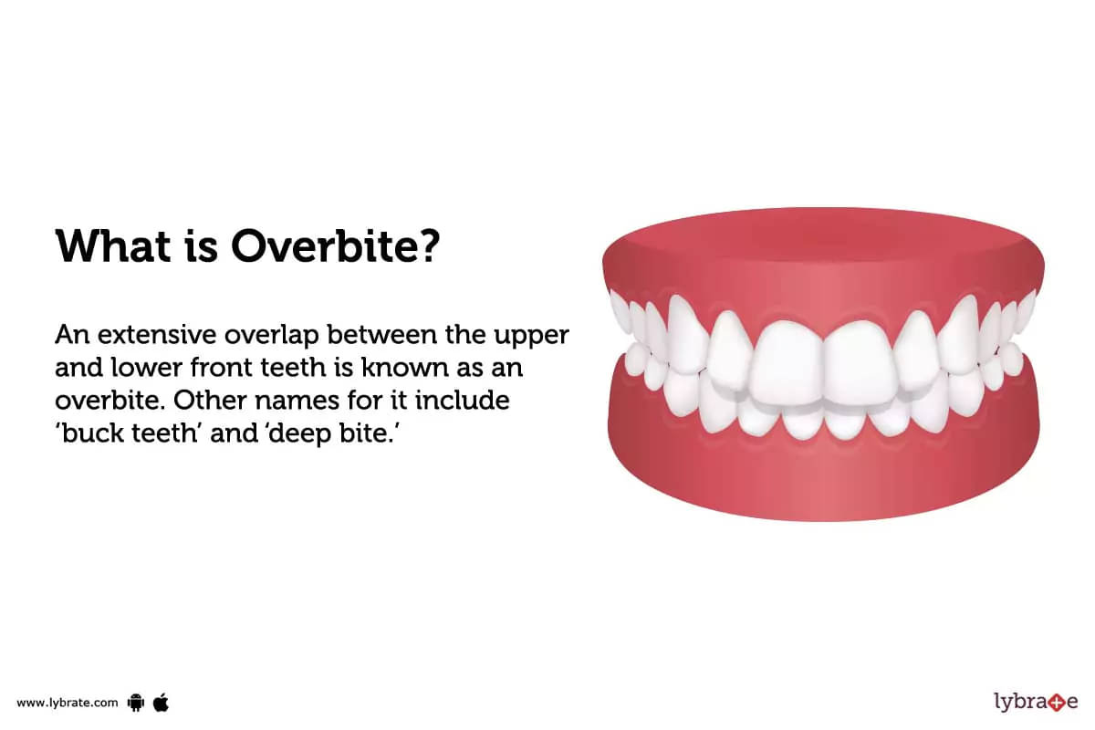 bad overbite teeth
