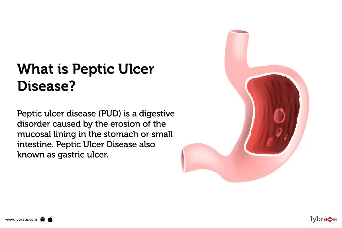 stomach ulcer pain location