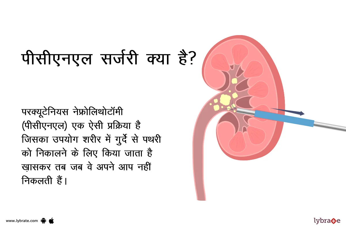 पीसीएनएल सर्जरी क्या है?