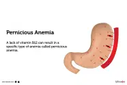 Pernicious Anemia Definition Symptoms Causes Treatment 40 OFF