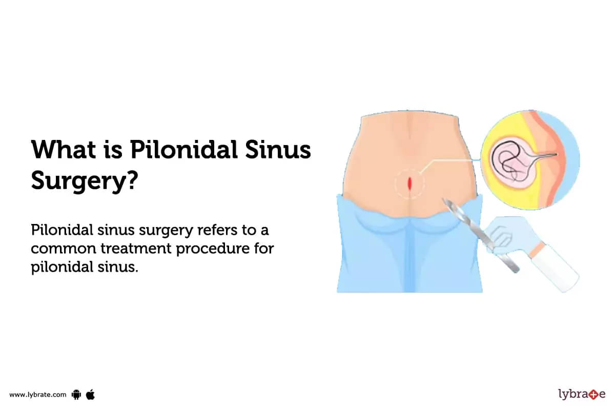 Pilonidal Sinus Surgery: Purpose, Procedure, Benefits and Side Effects