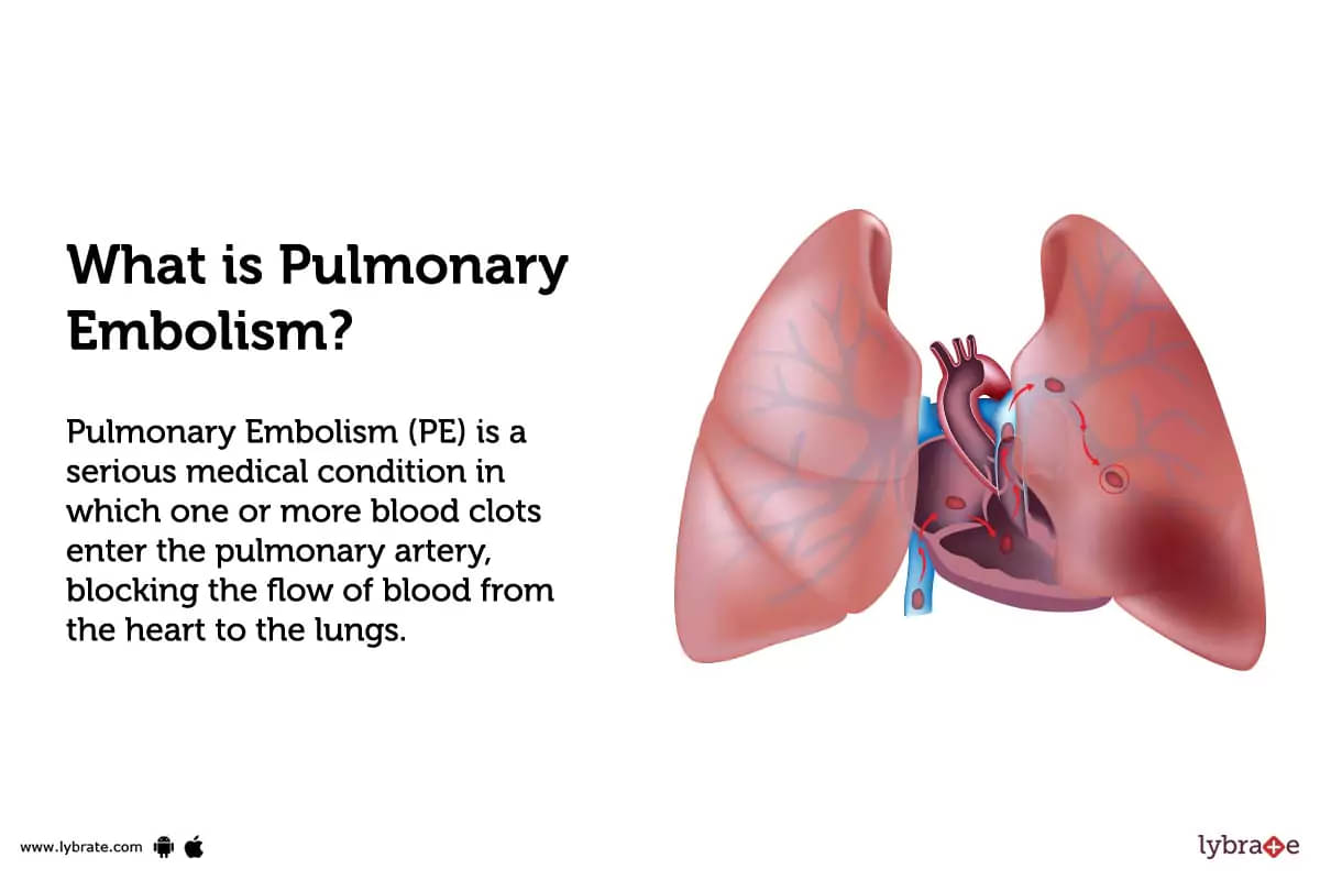 Pulmonary Embolism Causes Symptoms Treatment And Cost