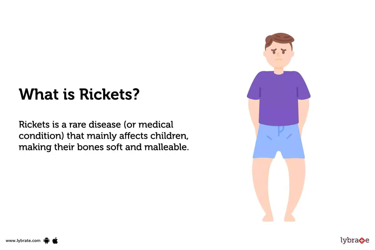 rickets in babies