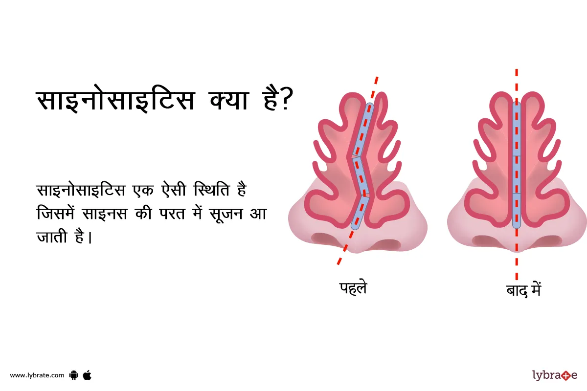 सेप्टोप्लास्टी क्या है - What is Septoplasty in Hindi