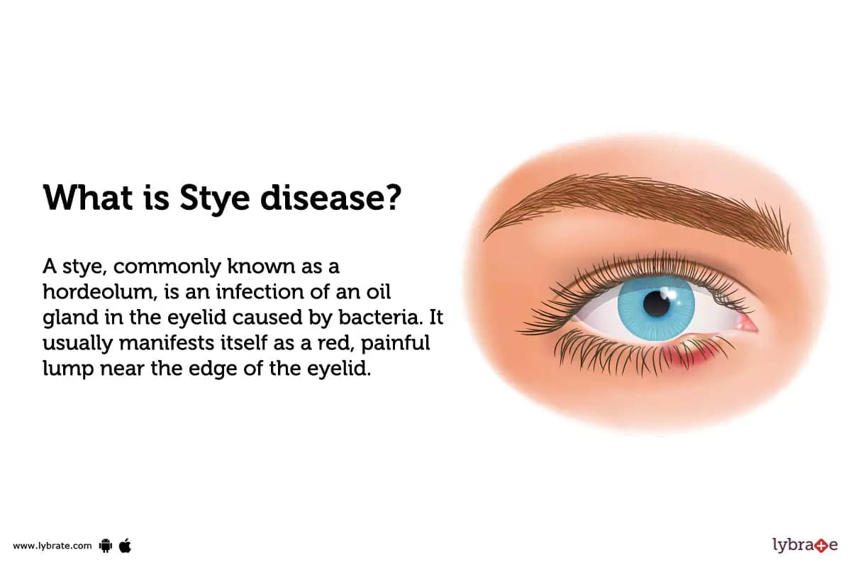 Stye (Sty): What It Is, Causes, Symptoms & Treatment