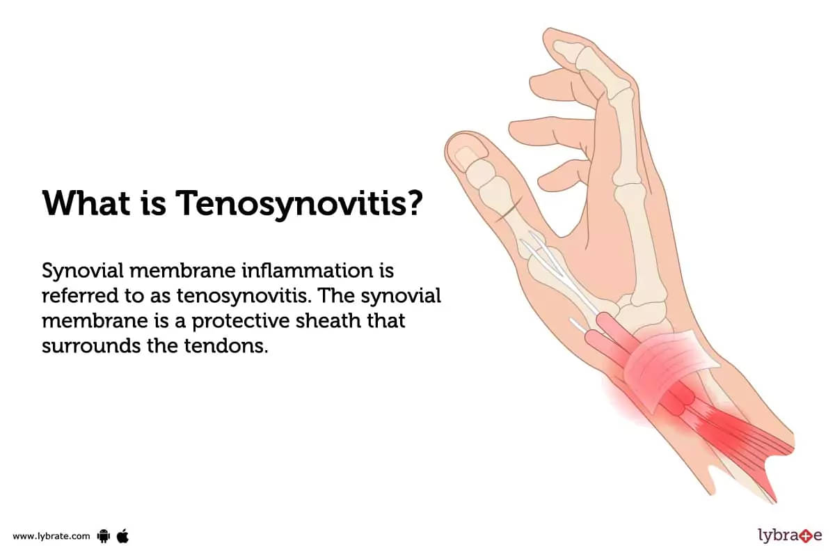 Tenosynovitis Treatment Procedure Cost Recovery Side Effects And More