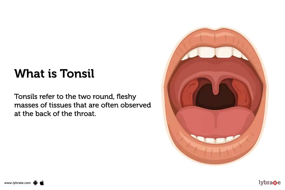 Tonsilstonsillitis Causes Symptoms Diagnosis And Treatment