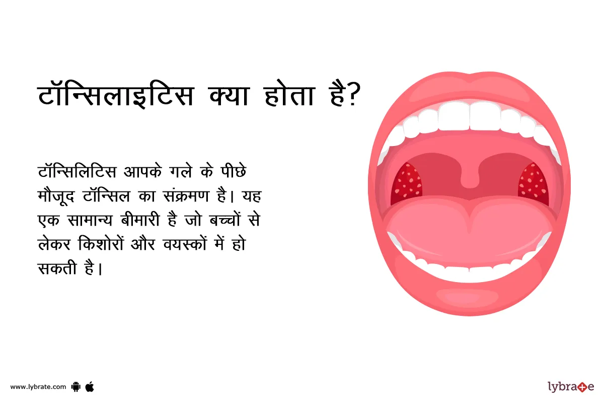 टॉन्सिलाइटिस क्या होता है?