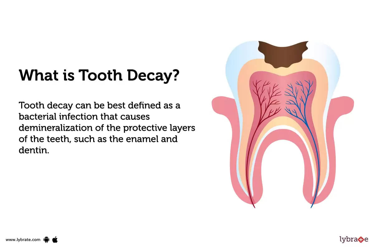Tooth Decay Causes, Treatment, Home Remedies And More!