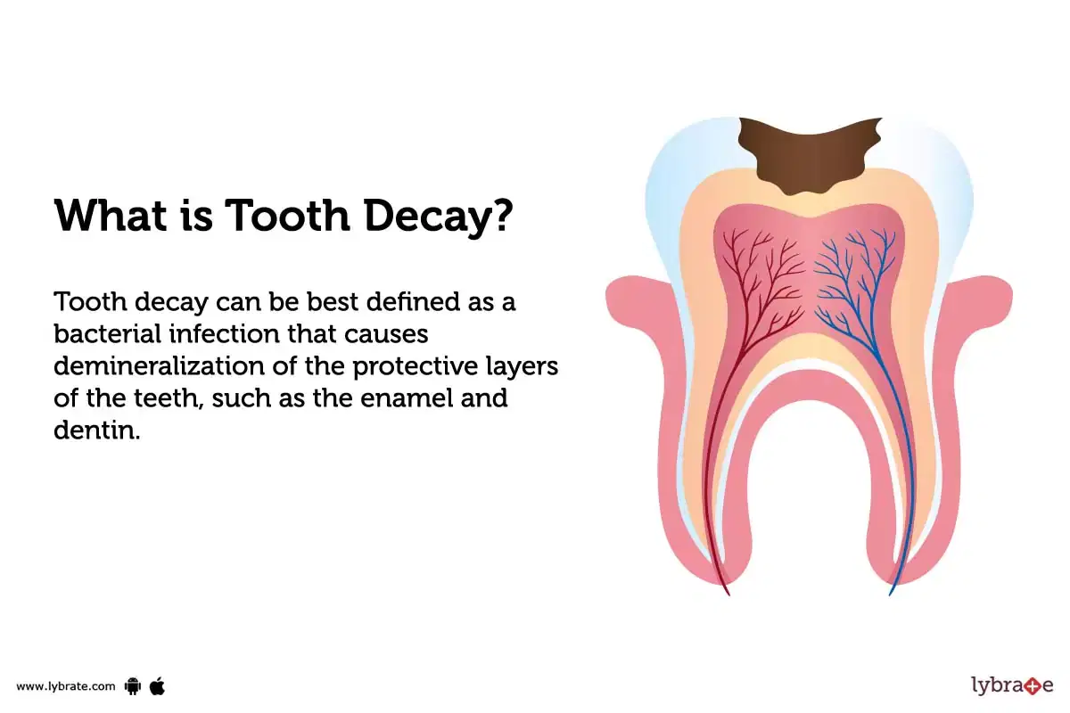 Pediatric Dental Cavity Treatment Options for Infant Teeth