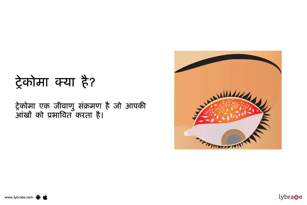 ट्रेकोमा क्या है? | Trachoma kya hai?