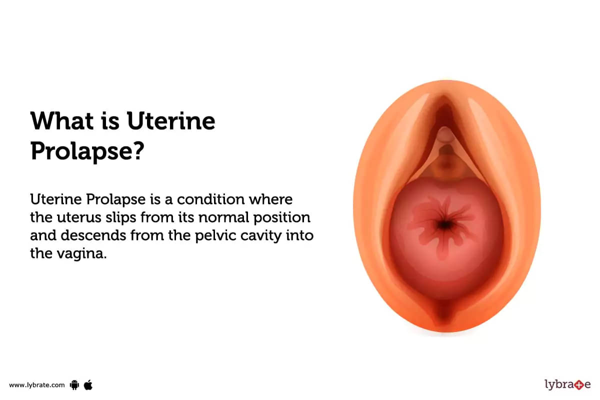 UTERINE - fallen uterus -  - All About Vaginal