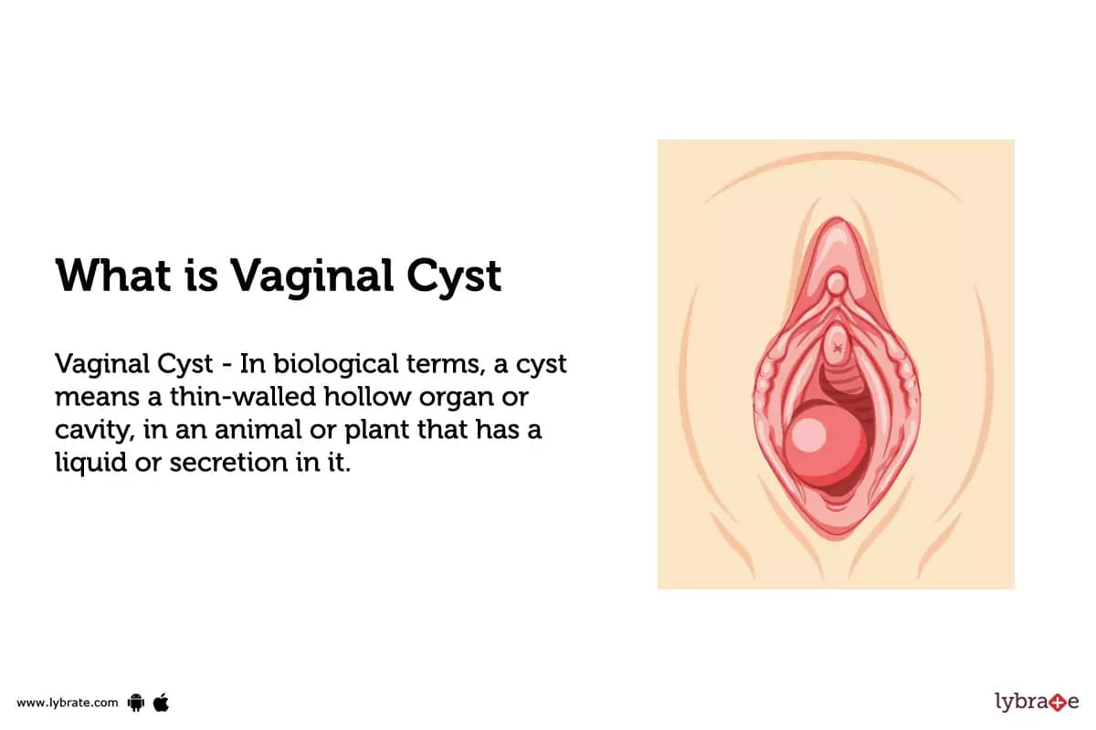 ASMOINTERNATIONAL on X: Causes of Vaginal Cysts .