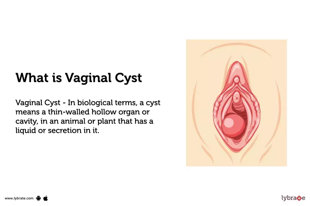 Vaginal Cyst Symptoms, Causes, Treatment and Cost