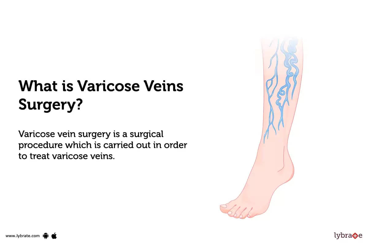 Vascular Recovery: Aftercare & Compression Stockings for Varicose