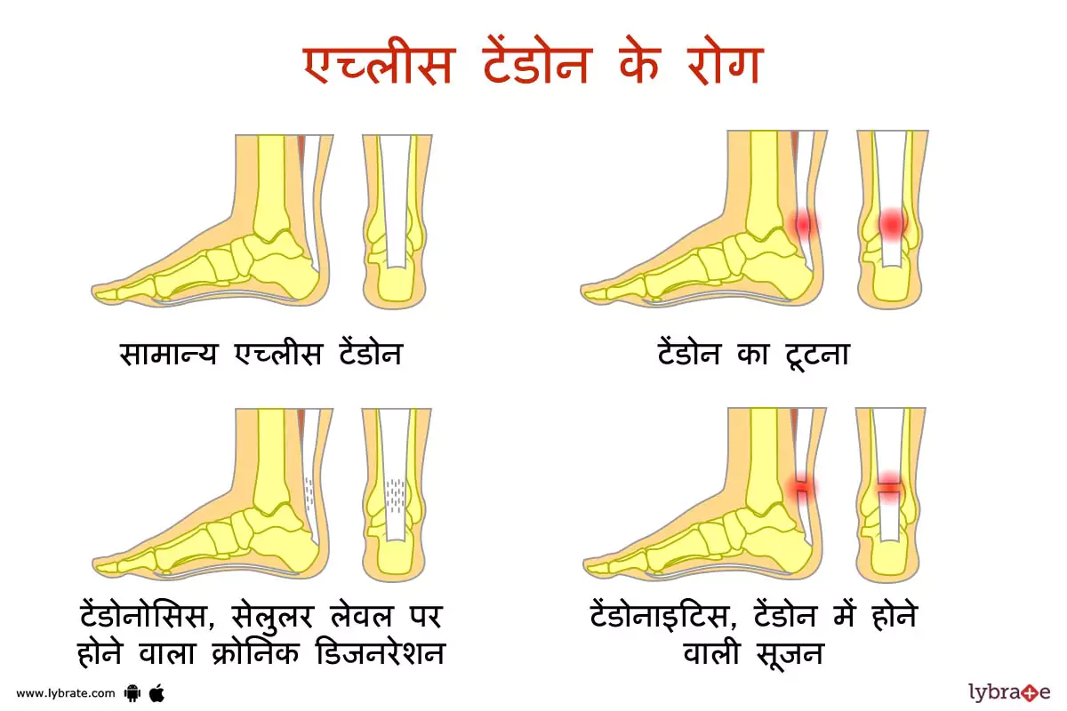 अकिलिस टेंडन के रोग | Achilles Tendon Ki Bimariya