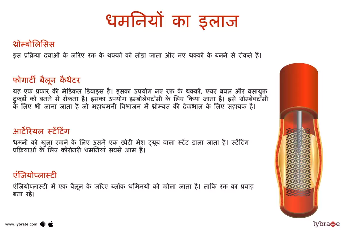 आर्टरीज़ का इलाज | Arteries Ki Bimariyon Ke Ilaaj