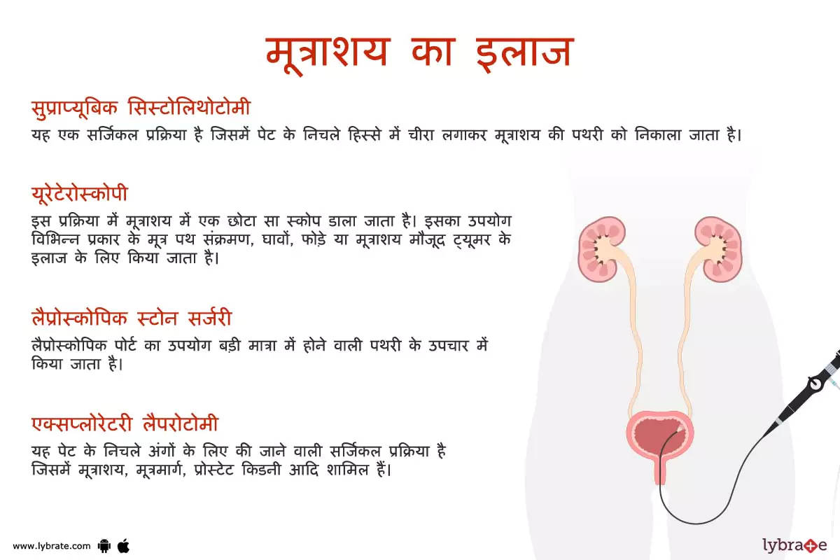 मूत्राशय (ब्लैडर) का इलाज | Bladder Ki Bimariyon Ke Ilaaj