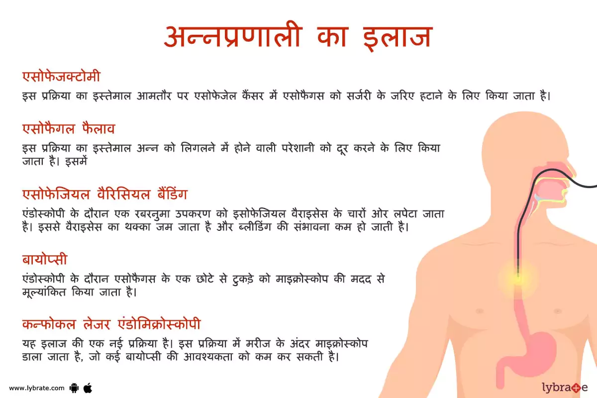 एसोफैगस(अन्नप्रणाली) का इलाज | Esophagus Ki Bimariyon Ke Ilaaj